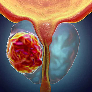 سرطان پروستات در چه سنی شایع‌تر است؟