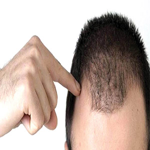 راه‌های پرپشت شدن مو در آقایان