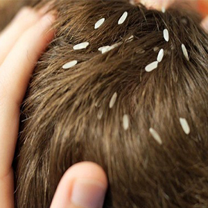 بهترین راه برای درمان شپش موی کودکان