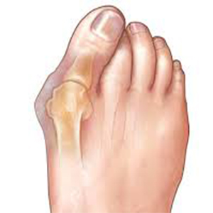 انحراف انگشت شست پا را چگونه درمان کنیم؟