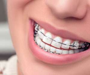 ارتودنسی دندان: سوالاتی که باید پاسخ آن را بدانید