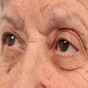 چشم ها علایم اولیه بیماری آلزایمر را نشان می دهند