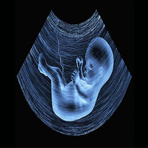هشدار انجمن علمی پریناتولوژی ایران نسبت به عواقب حذف برنامه غربالگری جنین