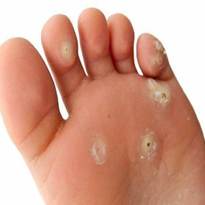 ۱۲ دستورالعمل طبیعی برای درمان میخچه پا
