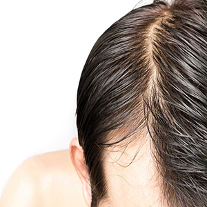 چند درمان خانگی برای کنترل چربی موی سر