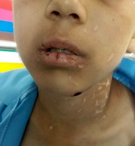 شکنجه شدید کودک ۹ ساله از سوی پدر و نامادری