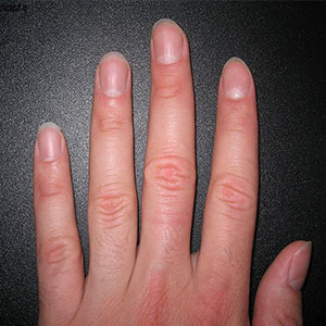 تغییر شکل انگشتان، نشانه‌ای از یک بیماری مهلک