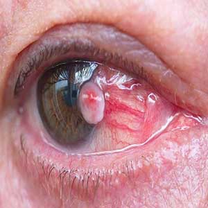 علائمی که نشان دهنده ابتلا به سرطان چشم هستند