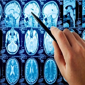 نتایج مثبت کارآزمایی فناوری اسید نوکلئیک در درمان سرطان مغز