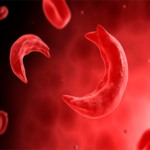 درمان خوراکی پایانی برای کم خونی سلول داسی ‌شکل