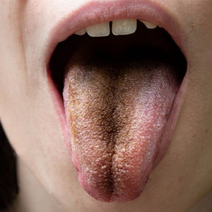 ۷ دلیل احتمالی ایجاد لکه‌های تیره بر روی زبان