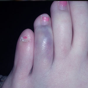 سندرم انگشت پای آبی چیست؟