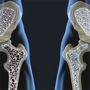 حدود ۵۰ درصد افراد مبتلا به پوکی استخوان دچار شکستگی لگن می‌شوند