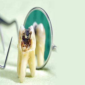 دلایل پوسیدگی دندان با وجود رعایت بهداشت دهان و دندان