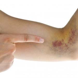 لکه‌های آبی روی پوست نشانه کدام بیماری خطرناک است؟