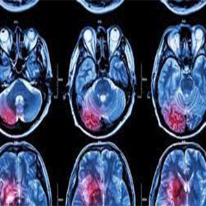 کشف روشی موثر برای درمان یک سرطان مغزی نادر در کودکان