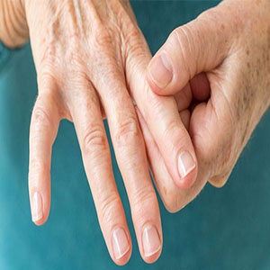 زنان ۲ برابر مردان به بیماری آرتریت روماتوئید مبتلا می‌شوند
