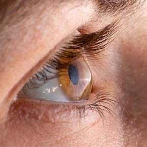 تشخیص کلسترول بالا از روی چشم ها
