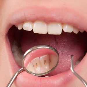 خوراکی‌هایی که به سلامت دندانها آسیب می‌زند