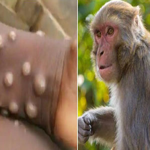 ویروس "مانکی بی" یا "آبله میمونی" چقدر خطرناک است؟
