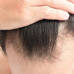 افزایش تراکم مو با چند روش خانگی