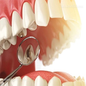 با این 6 روش هیچگاه دیگر دچار پوسیدگی دندان نمی شوید!