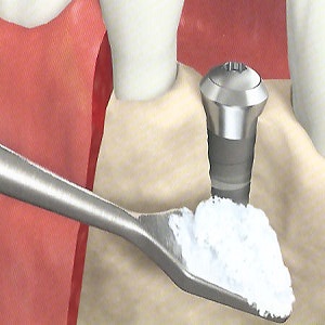 پودر استخوان و کاربرد آن در دندانپزشکی