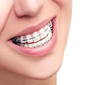 در مورد مراحل ارتودنسی دندان ها بیشتر بدانید