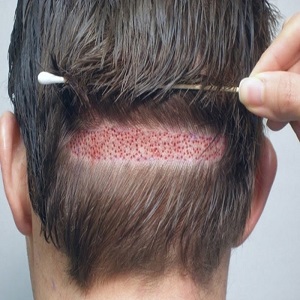 معایب خطرناک کاشت مو در کلینیک ها که باید بدانید