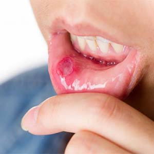 علت به وجود آمدن زخم دهان و زبان چیست؟