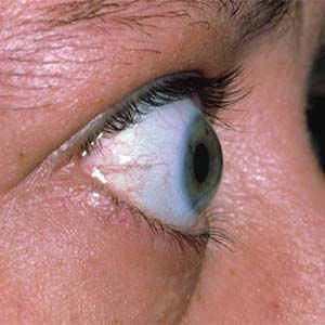 بیماری تیروئید چشمی و علائم آن