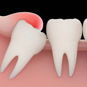 چرا دندان عقل دیر رشد می کند؟