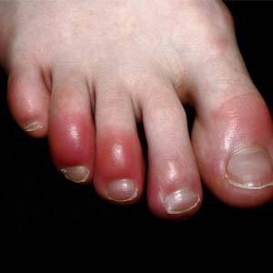 انگشت پای کوویدی؛ چیست و چرا ایجاد می‌شود؟