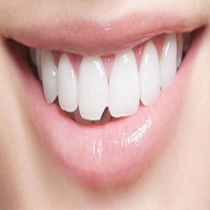 3 روش اصلی ترمیم دندان شکسته، ترک خورده یا لب پر شده