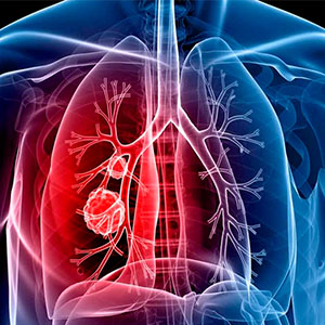 ارتباط آلودگی هوا با افزایش ابتلا به سرطان ریه