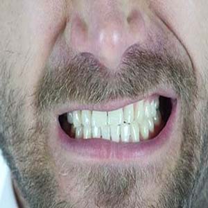 عارضه‌ دندانی که با استرس تشدید می‌شود